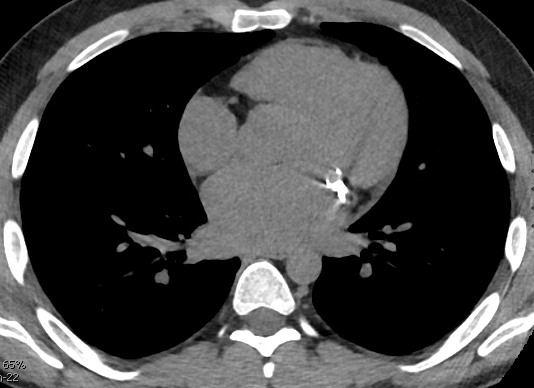 CT scan image of Ben Denny's heart