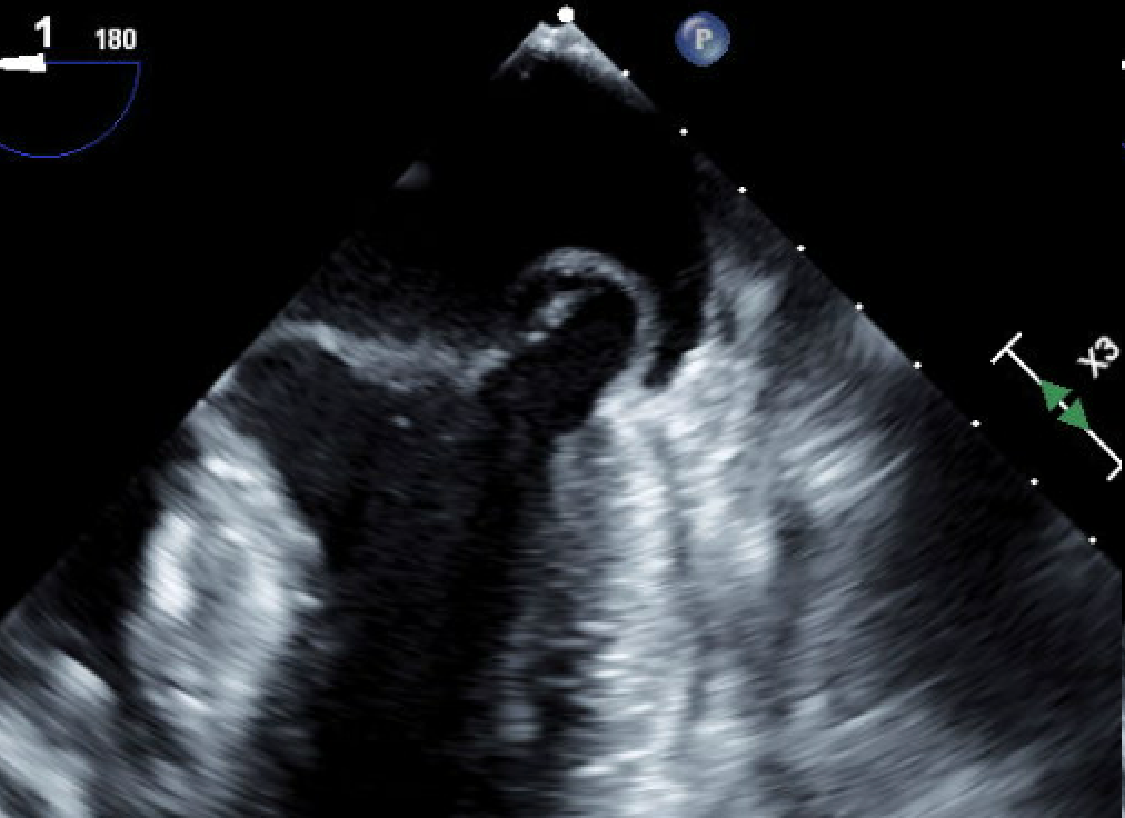 Transesophageal echocardiogram image of Ben Denny's heart